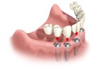 Full Jaw - Implant Bridge